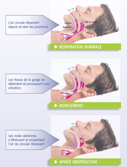 L apn e Du Sommeil Ses Cons quences Et Son Traitement Bastide Le L apn e Du Sommeil Ses Cons quences Et Son Traitement Bastide Le